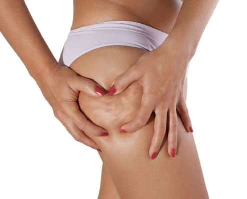 cellulite